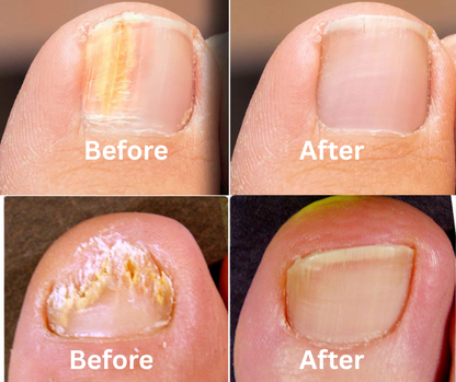 Dermfree Fungi Nail Treatment Liquid