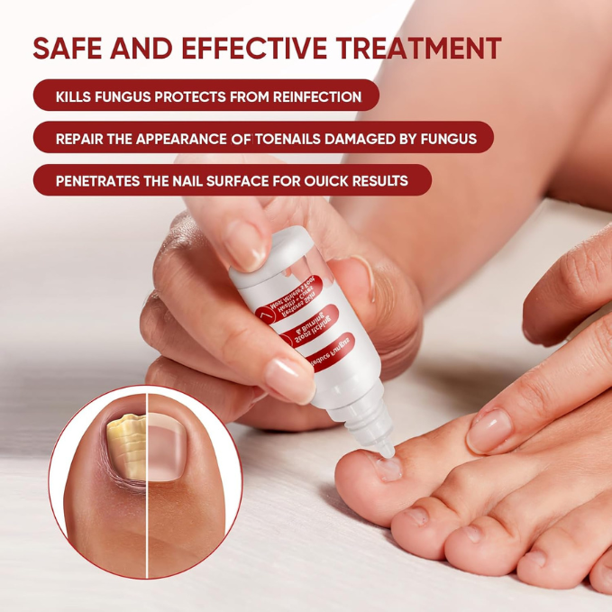 Dermfree Fungi Nail Treatment Liquid
